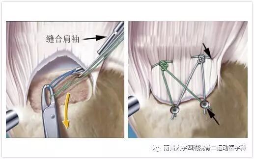 肩袖损伤修补术示意图肩袖损伤关节镜下操作图及术后x线复查结果