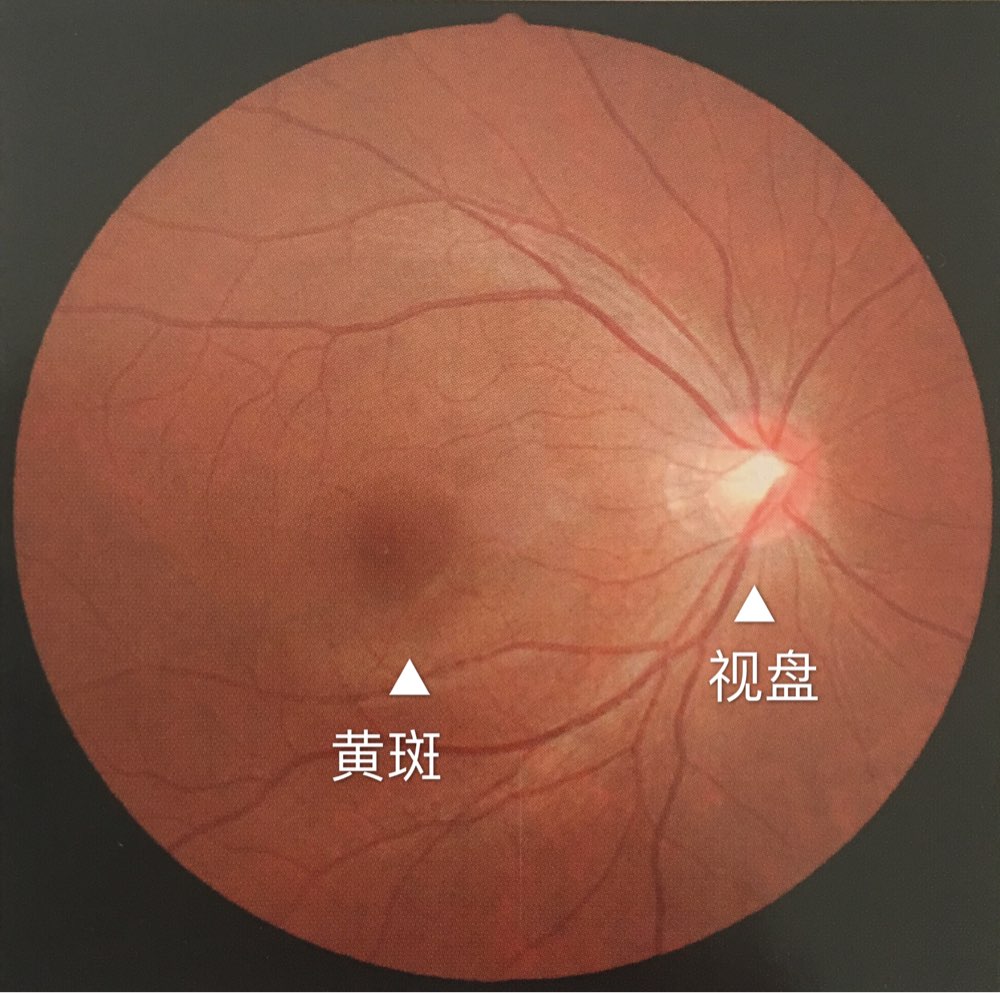 "其实,"黄斑"人人都有,是人眼球内部的一个正常结构.