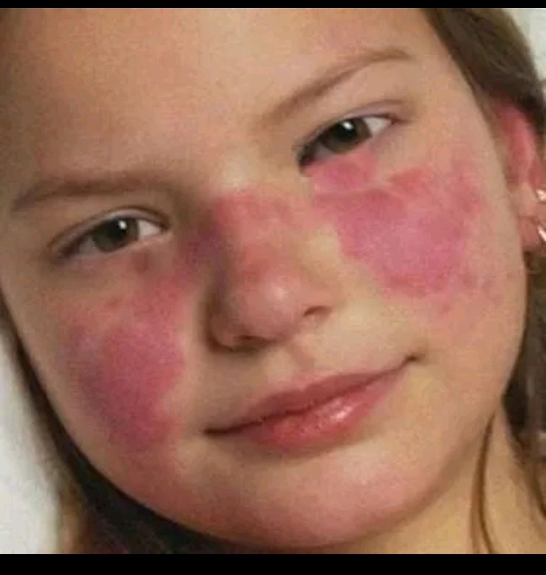 典型的蝶形红斑表现为颊部皮疹跨过鼻梁,出现在1/3~1/2的患病儿童中.