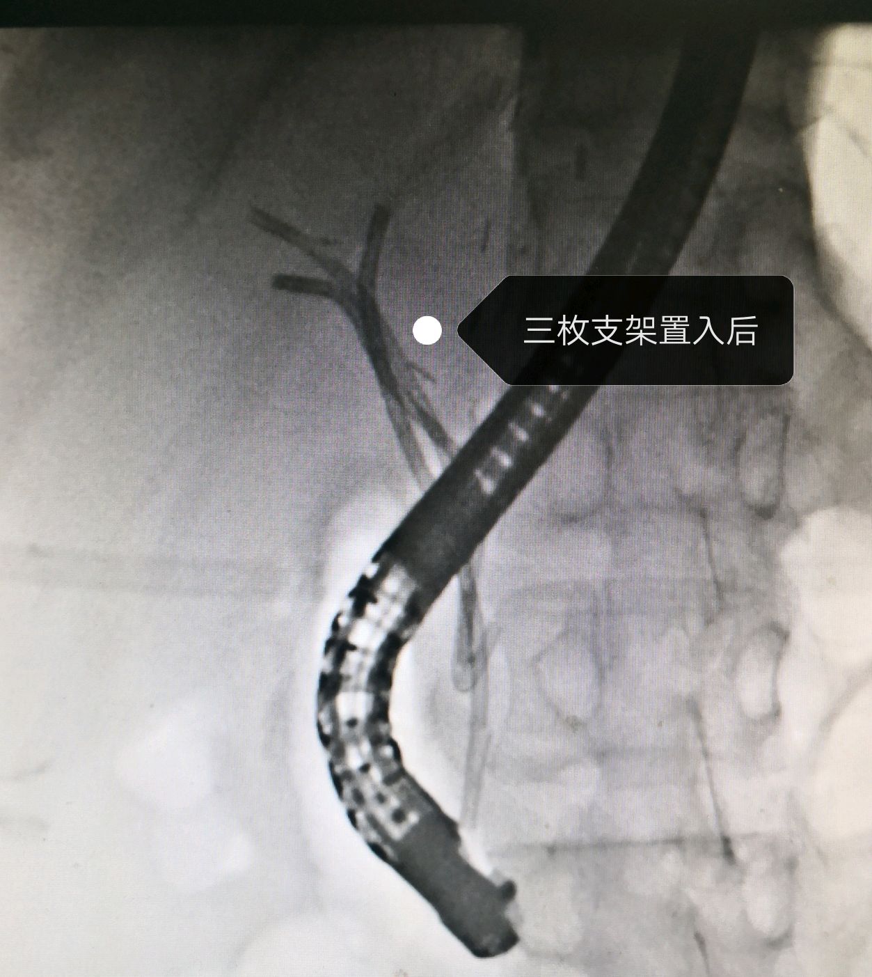 ercp治疗肝移植术后肝门部胆管狭窄