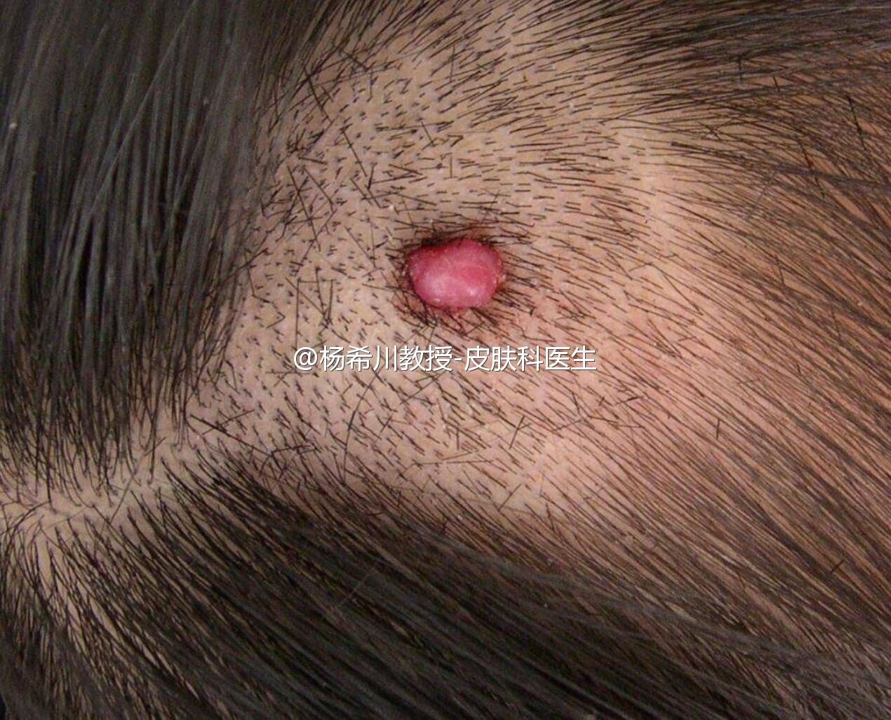 化脓性肉芽肿不是感染