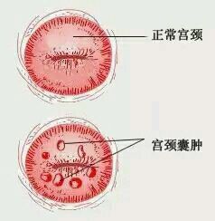 宫颈囊肿