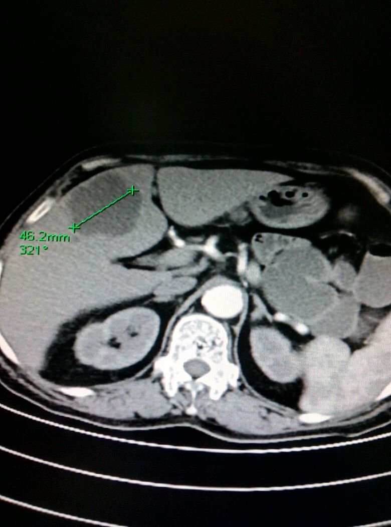 ct示:左肝内叶转移瘤!