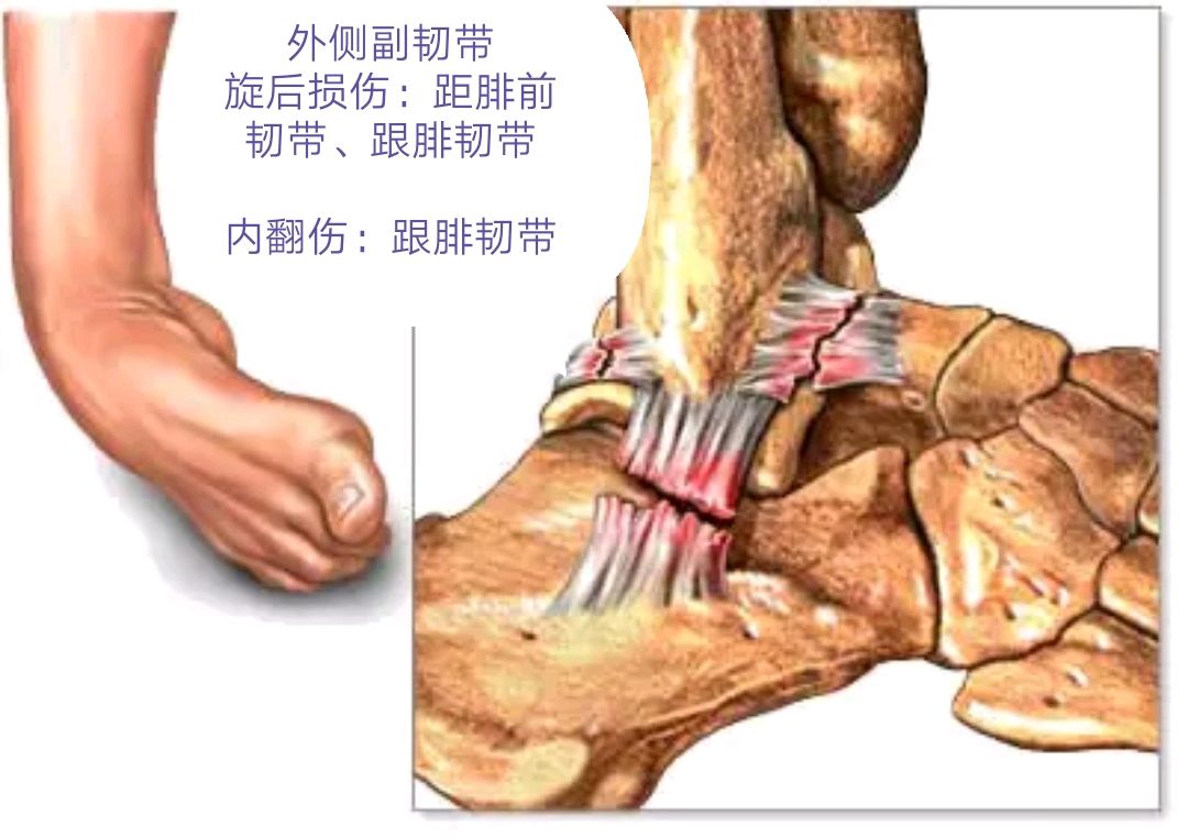 是骨科发病率最高的损伤 损伤机制: 外侧副韧带 旋后损伤:距腓前韧带