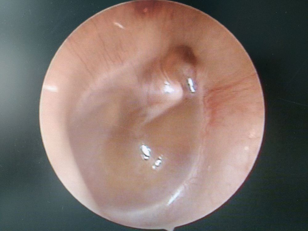 中耳炎耳镜检查危害图片_纵览新闻