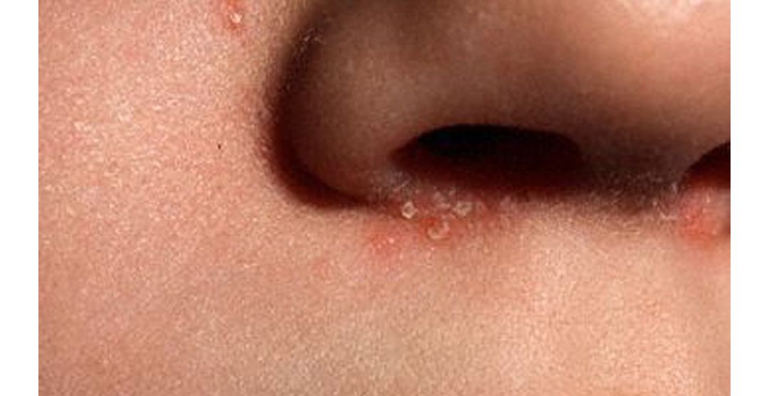 必知:面部脂溢性皮炎常见问题