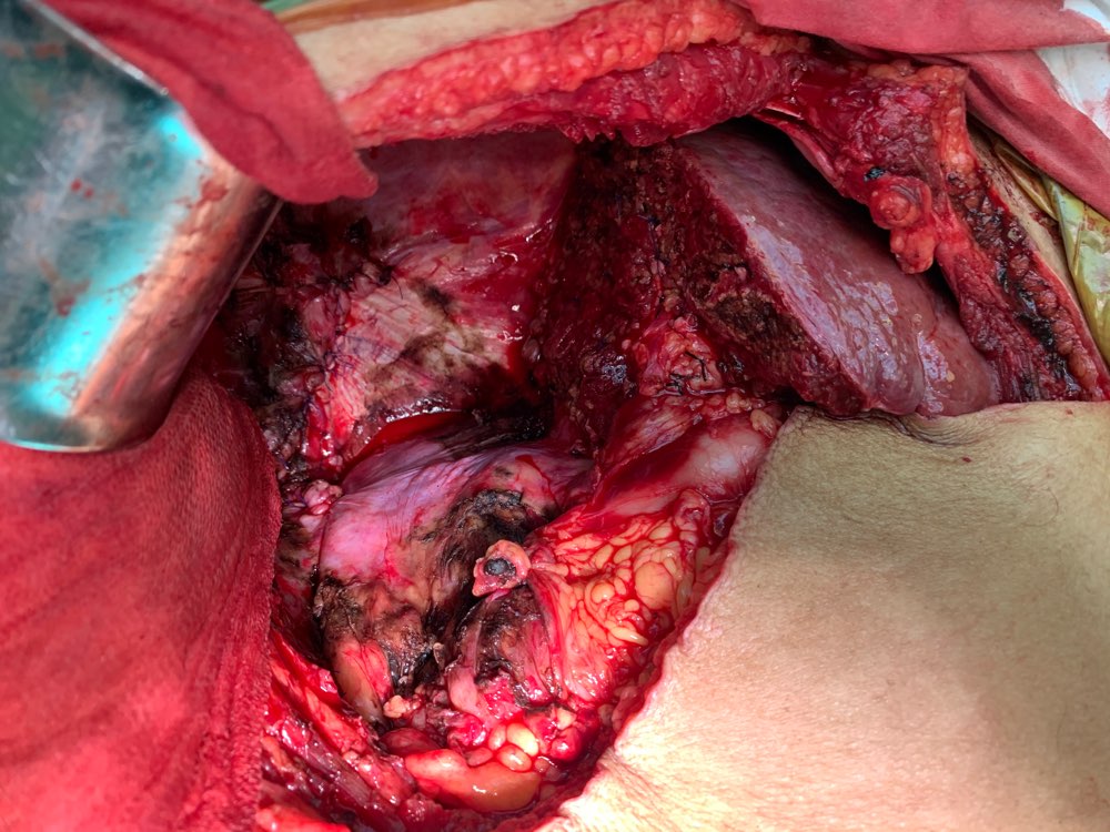mri检查显示右肝巨大肝癌,占满右侧腹腔:      提示:对于乙肝病人