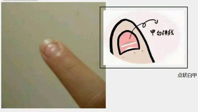 小儿先天性甲状腺功能低下也称呆小病,是因先天性甲状腺发育不良或