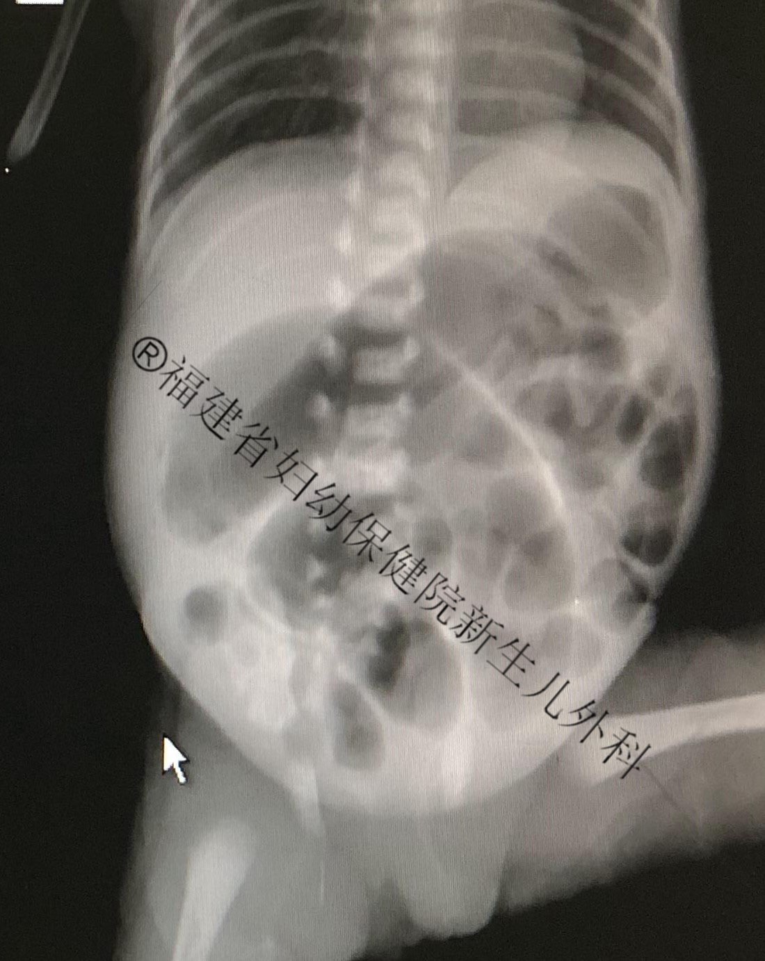 小孩肠梗阻x线图片图片