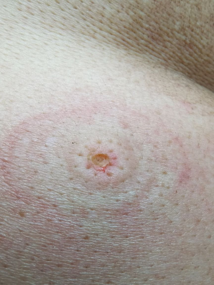 蜱虫咬人后的伤口图片图片