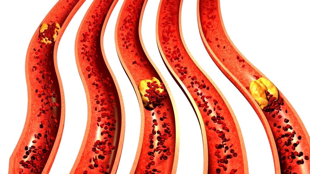 动脉钙化,硬化,粥样硬化,有什么不一样,危险性哪个大? - 春雨医生