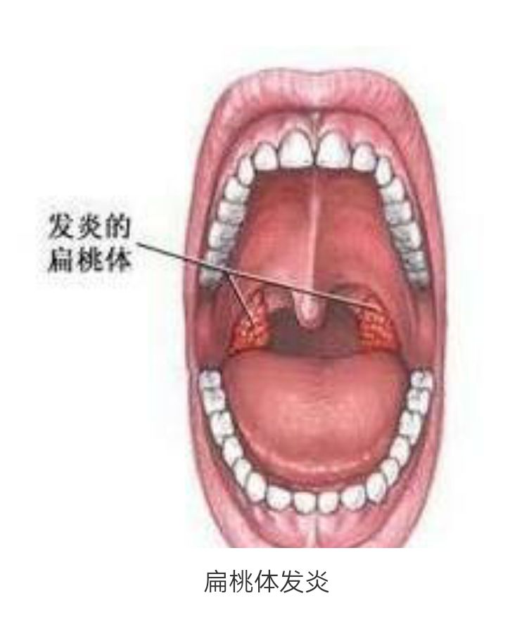 根据位置分为腭扁桃体,咽扁桃体和舌扁桃体