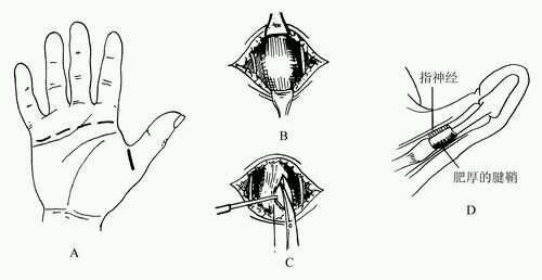 狭窄性腱鞘炎手术图解图片