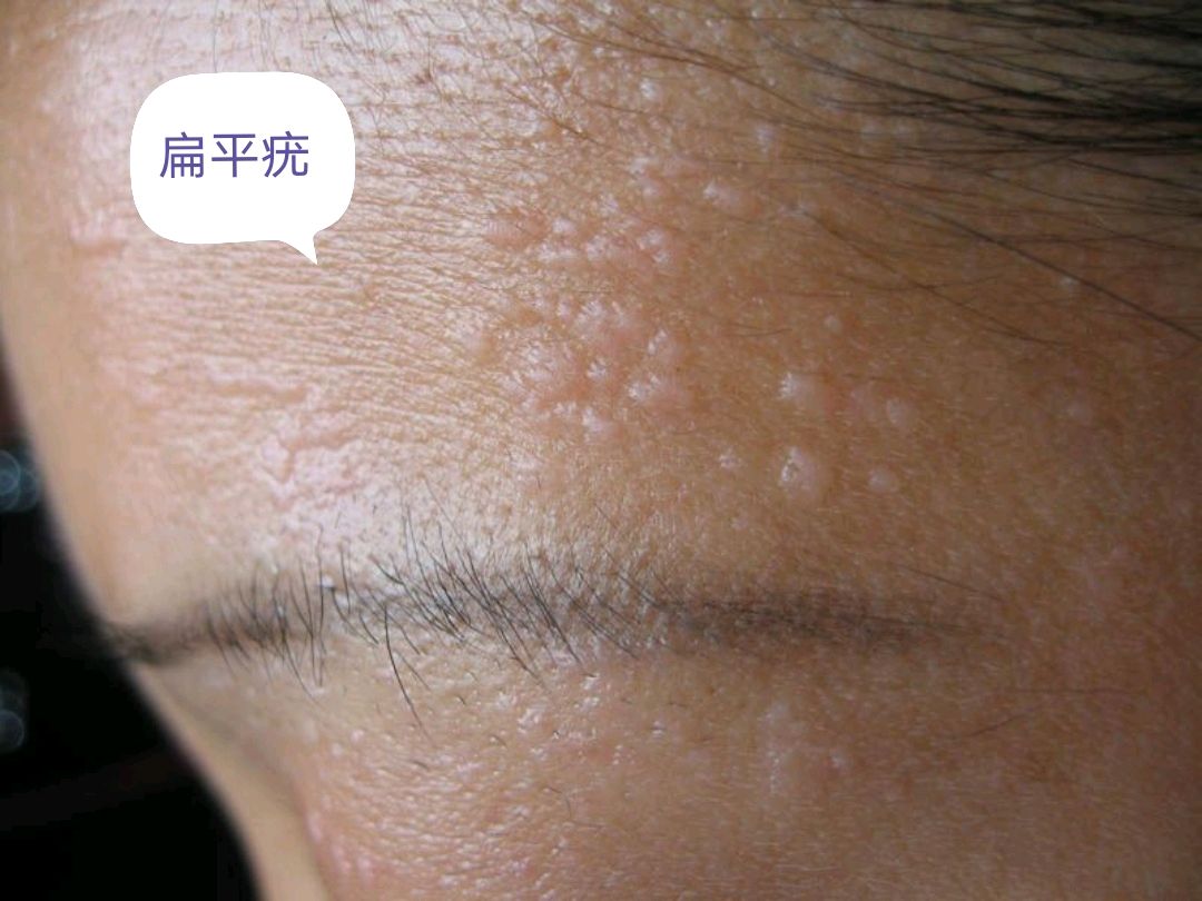 像这种一个一个的,摸上去硬硬的,表面比较粗糙,甚至是菜花状的,有的还