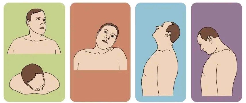 什么是痉挛性斜颈能预防吗