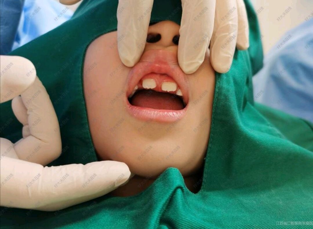儿童上颌埋伏多生牙拔除(病例)