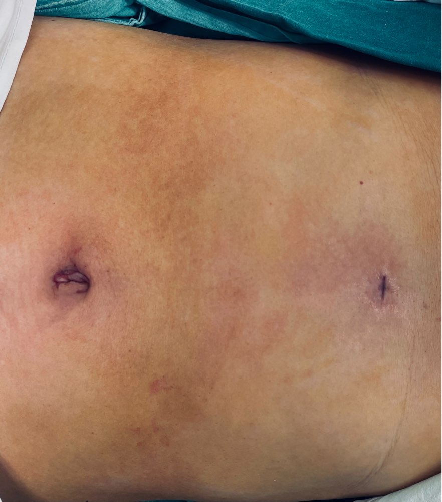 二孔法腹腔镜胆囊切除不修边幅创面图,脐周1.0cm,剑突下0.5cm小切口