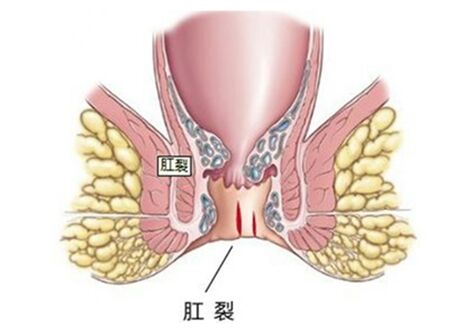 肛裂,即肛管的皮肤全层裂开,肛裂典型症状为周期性疼痛,久之形成梭形