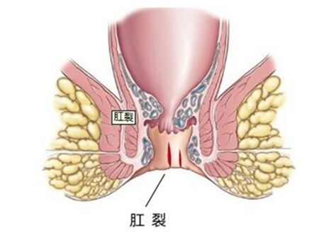 肛裂的症状三期图片