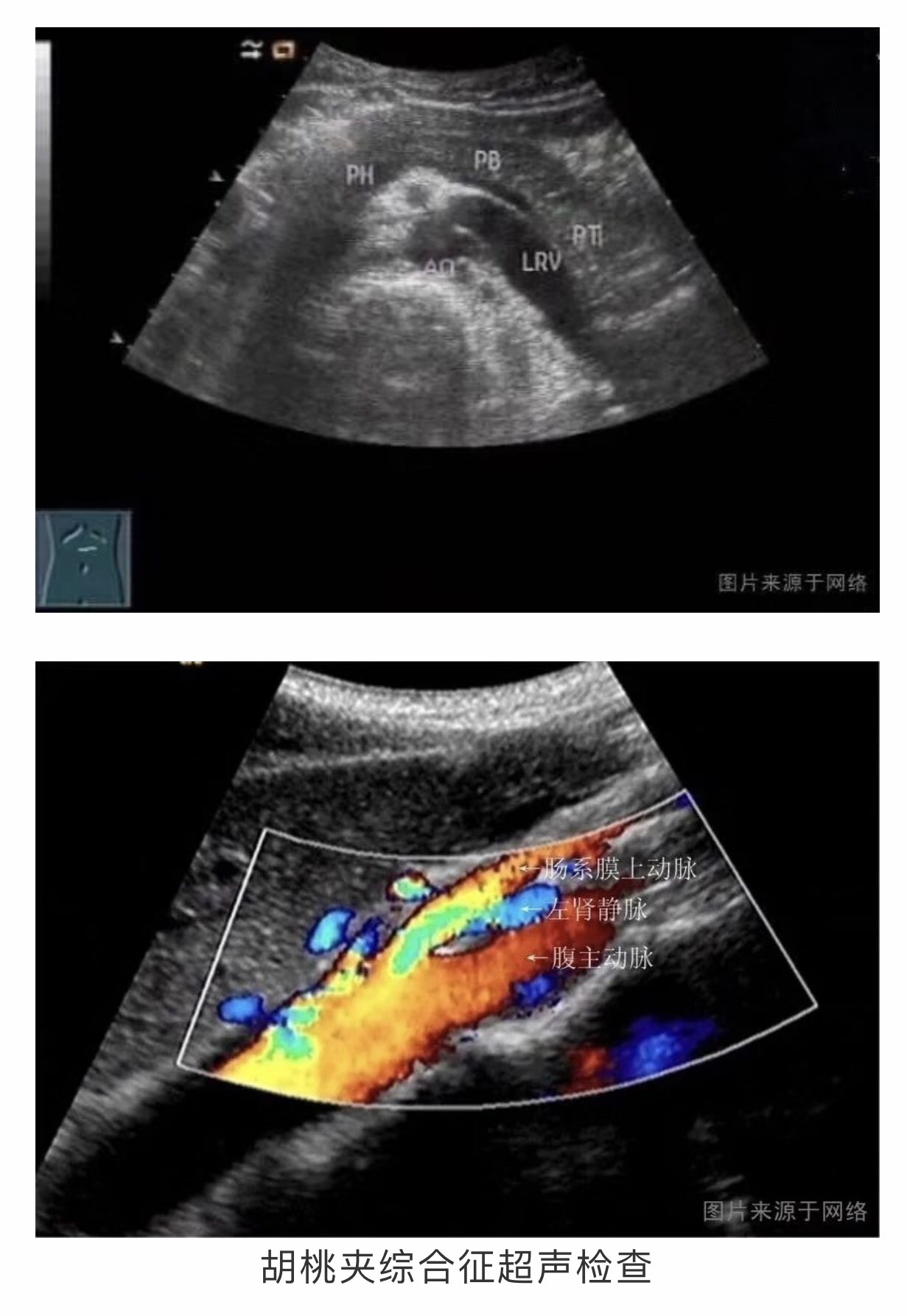 胡桃夹综合征超声图片