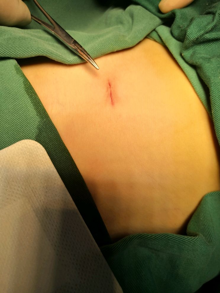 阑尾炎术后切口疝图片图片