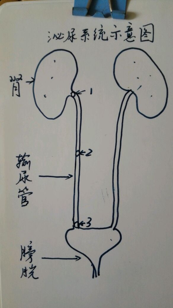 输尿管结石怎样排出图片