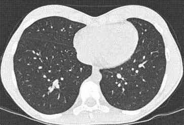 肺部結節多大就可以查petct