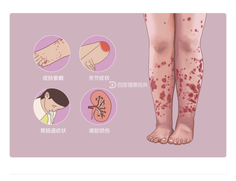 过敏性紫癜你了解多少
