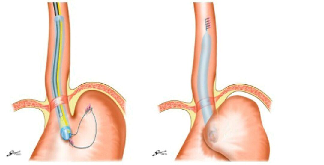 图 1 poem 部分胃底折叠术示意图另外来自日本昭和大学的 haruhiro