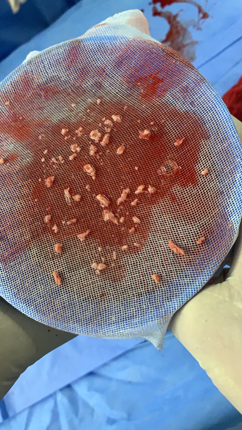 防血栓的重要性