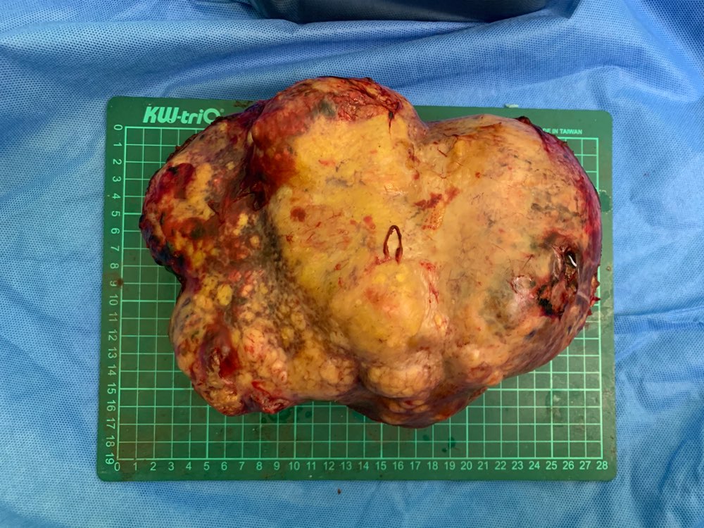 乙肝酗酒不体检被患者自己耽误的巨大肝癌