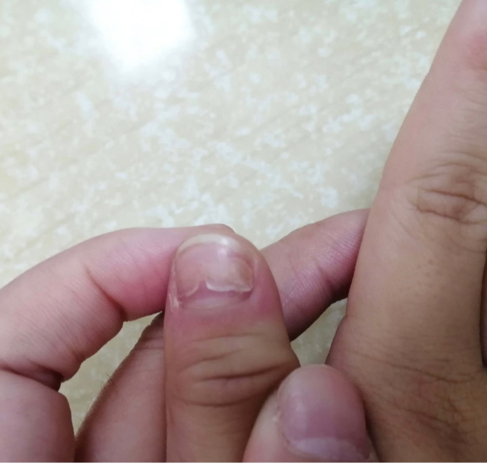 儿童甲脱落