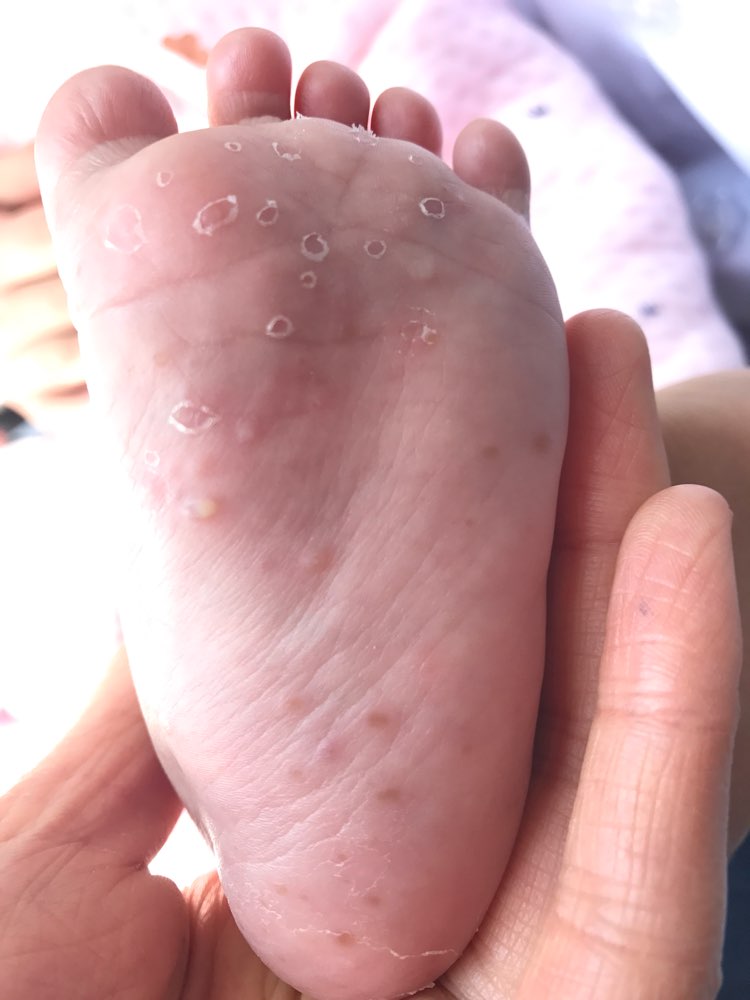 婴儿肢端脓疱病1例-春雨医生