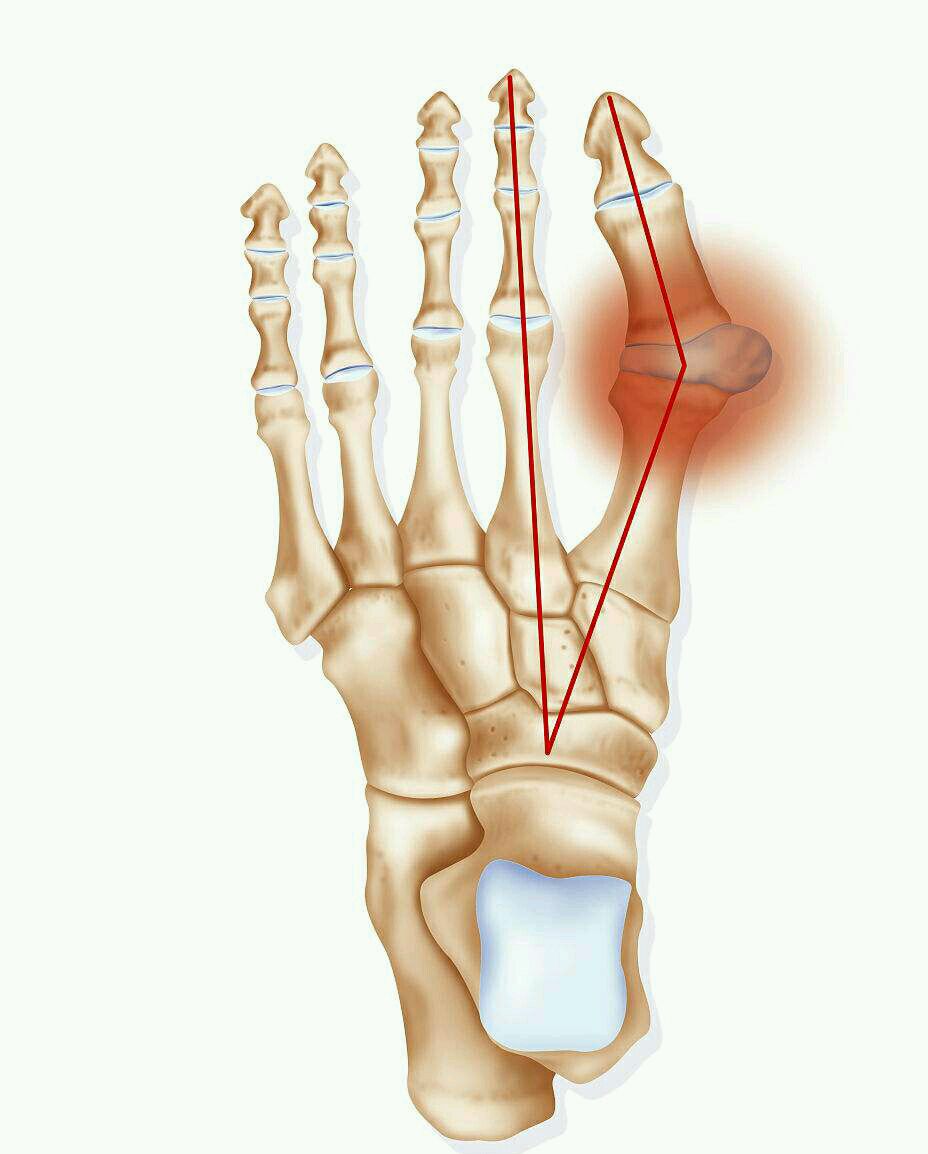 其实,这是出现了拇外翻畸形,就是大脚趾关节跖骨之间对位紊乱.