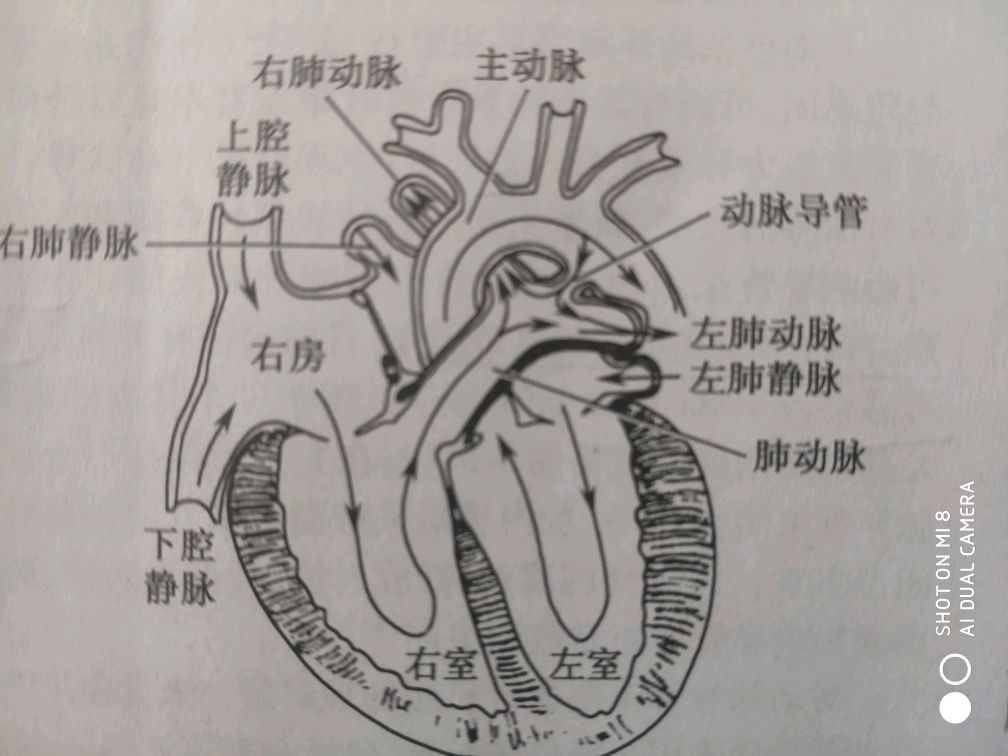 动脉导管未闭图解图片