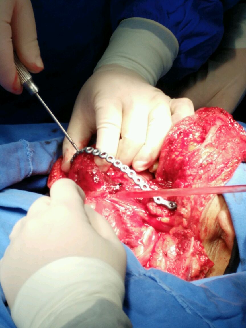 牙龈癌图片 手术图片