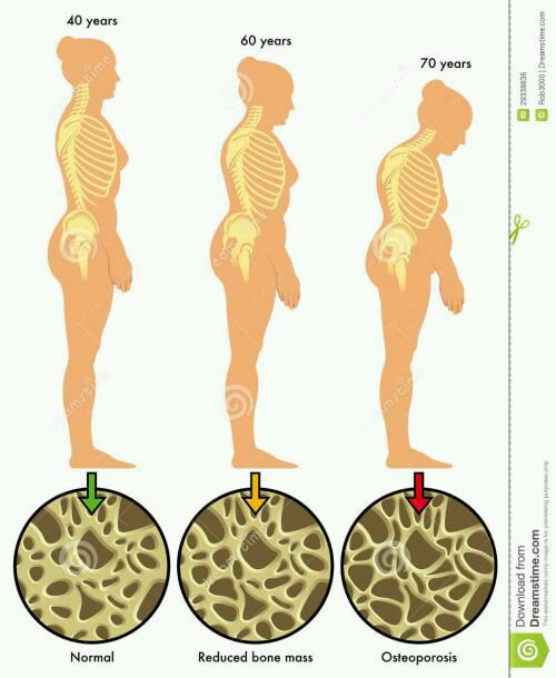 随着年龄的增大,人体骨质逐渐加速流失,骨小梁变稀疏变脆弱,尤其是