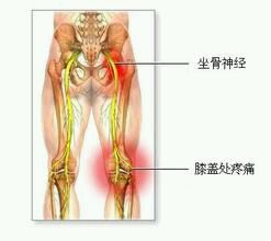 打针坐骨神经的位置图图片