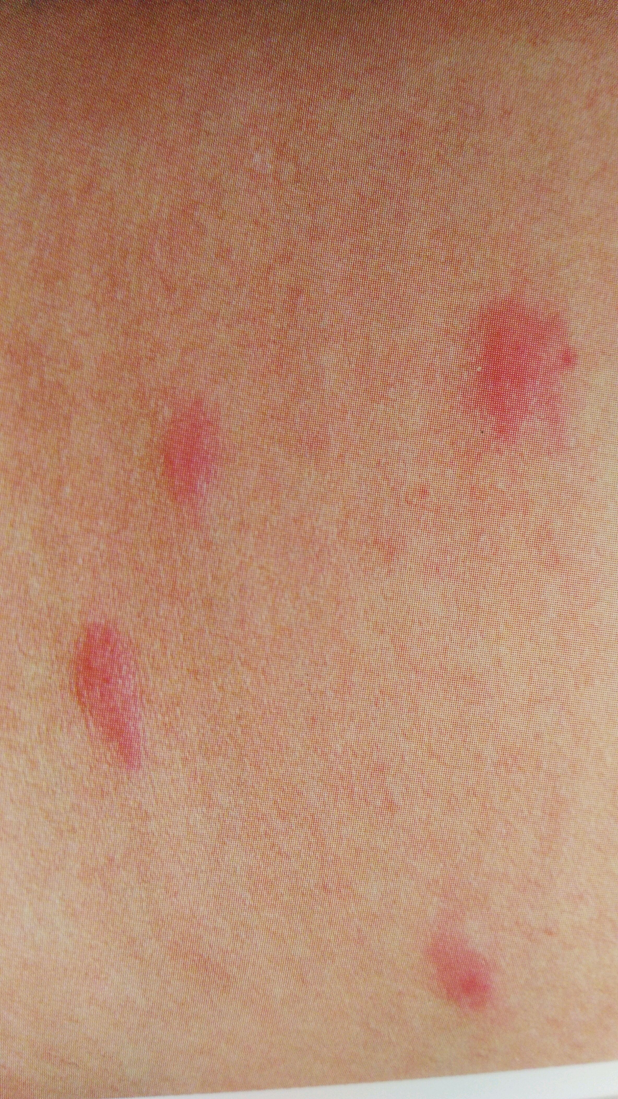 儿童常见季节性过敏性皮肤病-丘疹性荨麻疹