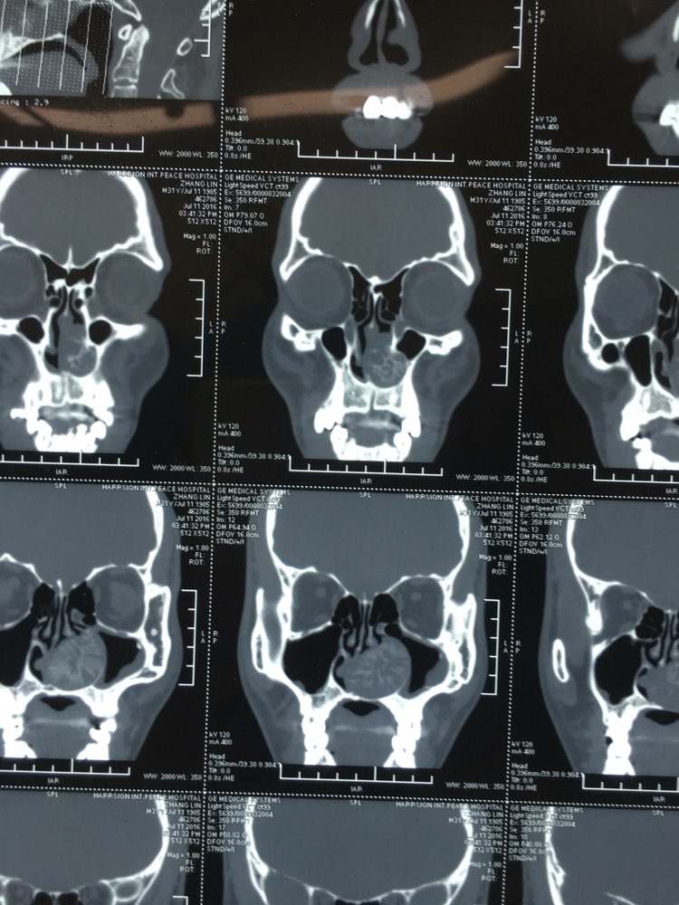 鼻竇ct罕見病例