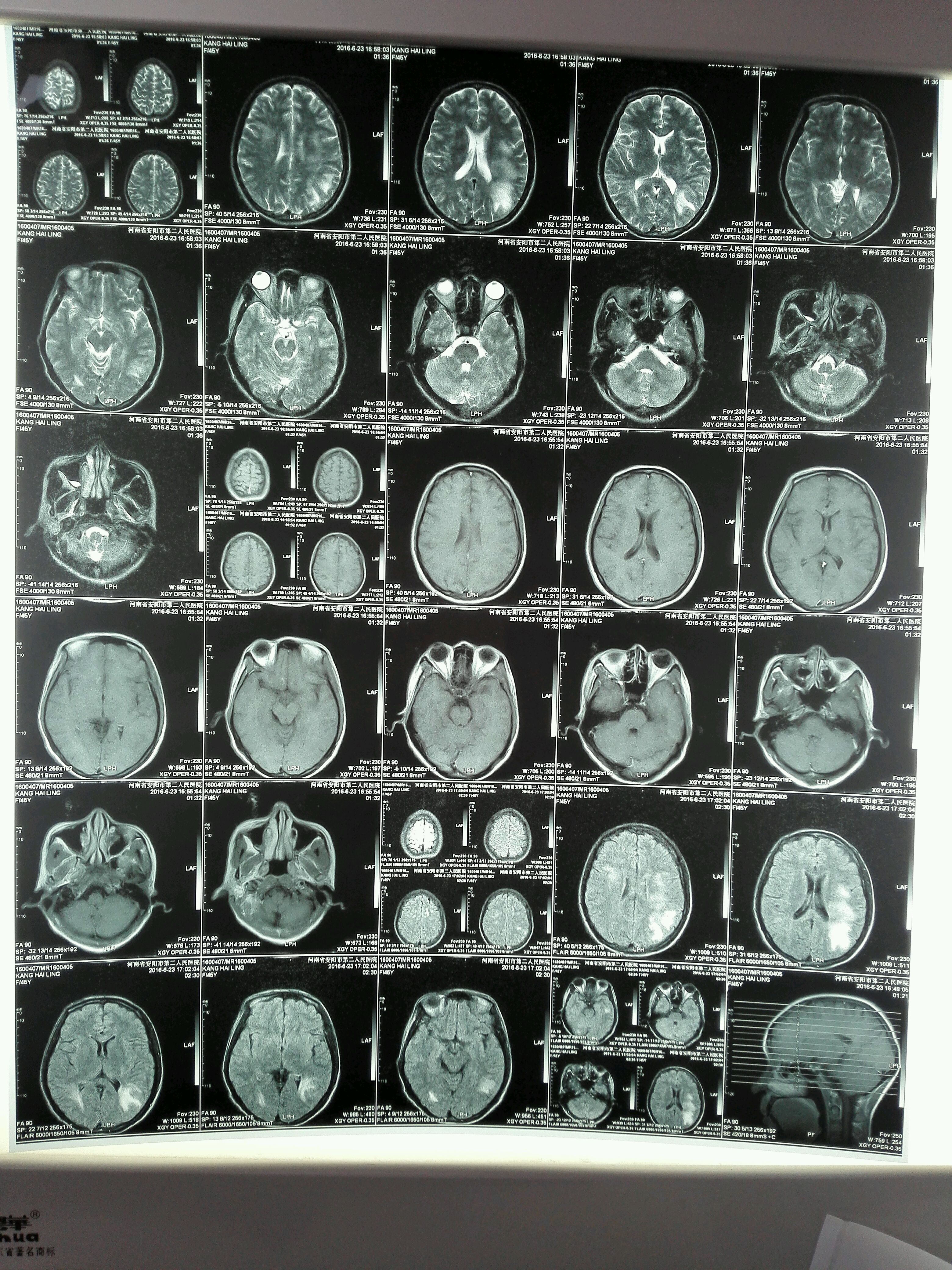 脑白质病变脑炎脱髓鞘