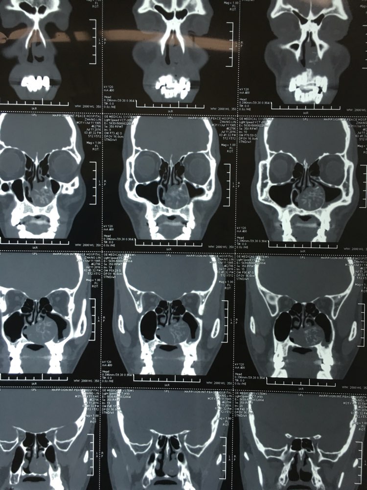 鼻竇ct罕見病例