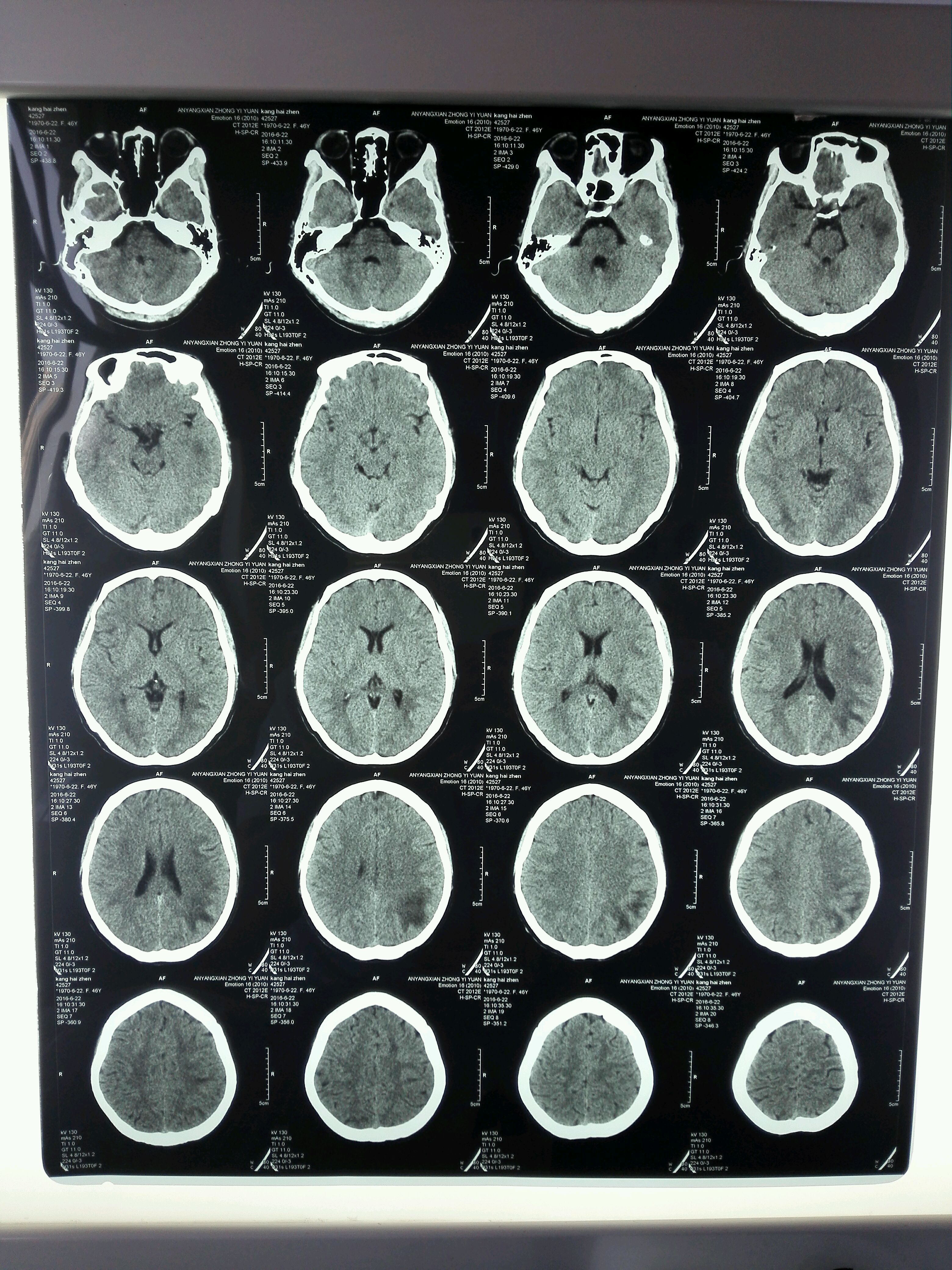 脑白质病变脑炎脱髓鞘