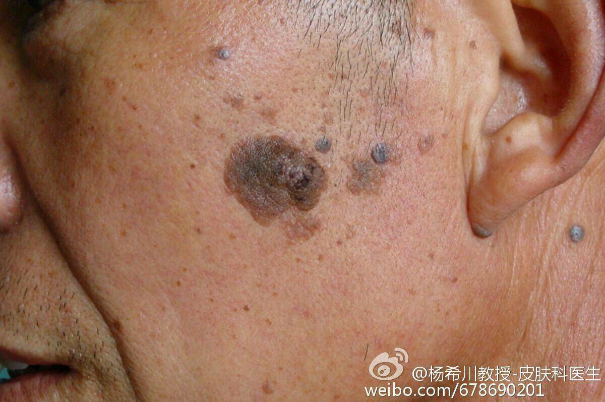 杨教授每周病例分享#:脂溢性角化 - 春雨医生