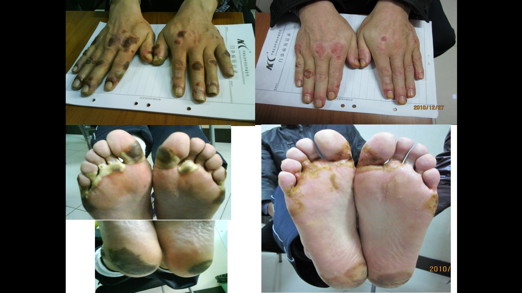 肿瘤治疗相关皮肤损伤案例介绍-春雨医生