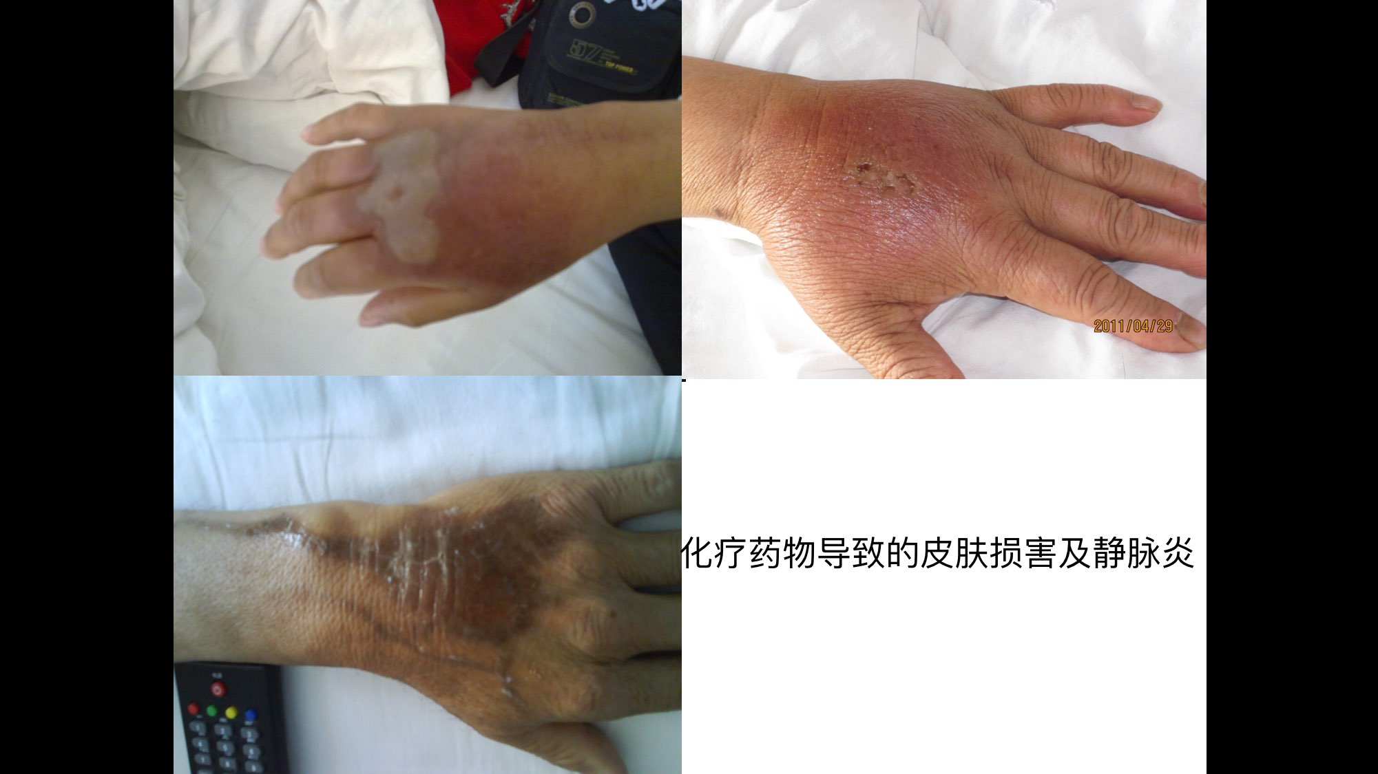 肿瘤治疗相关皮肤损伤案例介绍 - 春雨医生