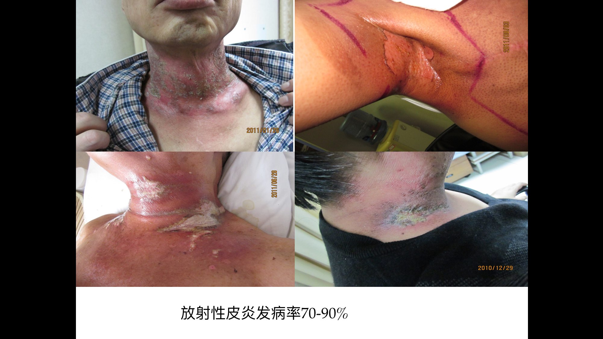 临床应用非常广泛,约87%的放疗患者会出现放射性皮肤反应,表现为红斑