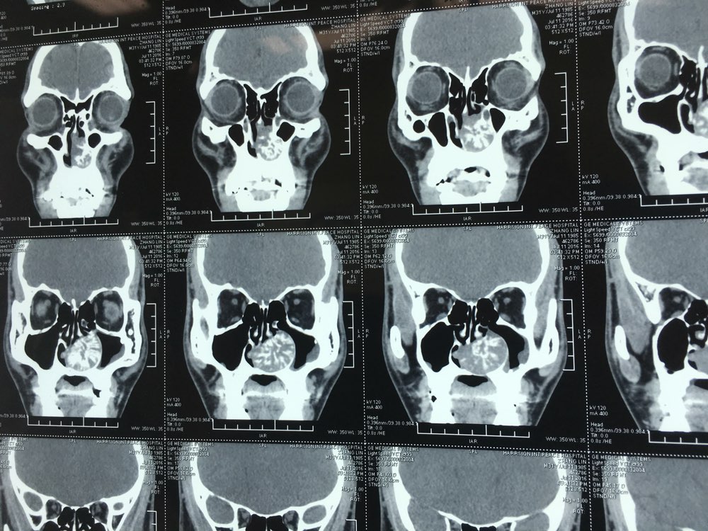鼻竇ct罕見病例 - 春雨醫生