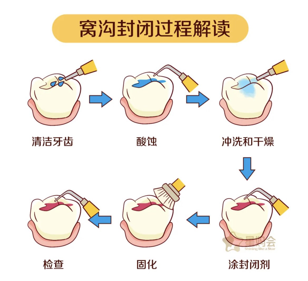 小朋友一定要做窝沟封闭吗?-春雨医生