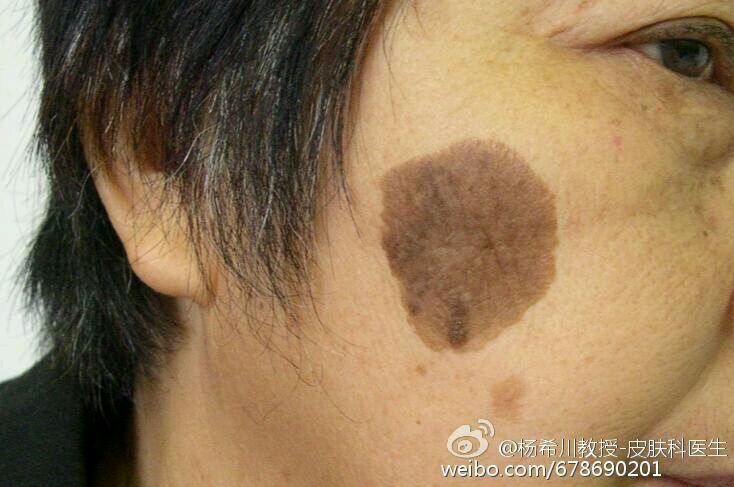 杨教授每周病例分享脂溢性角化